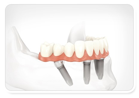 An example of All on 4 full dental implants