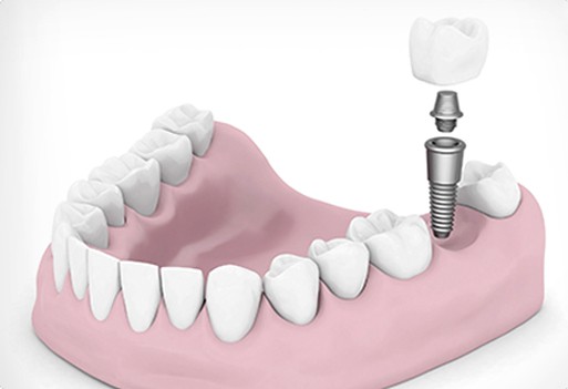 How dental implants work