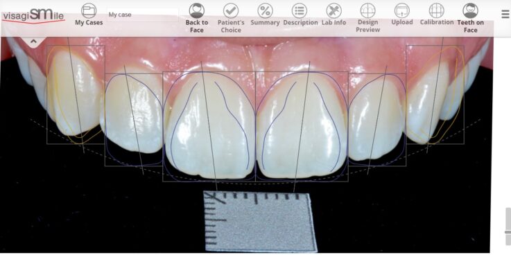 Smile Design