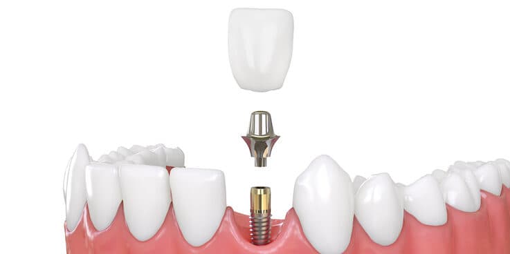 Single tooth dental implant