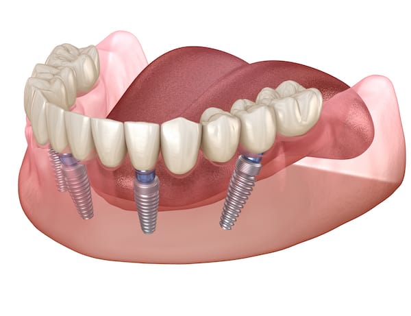 Example of dental implants