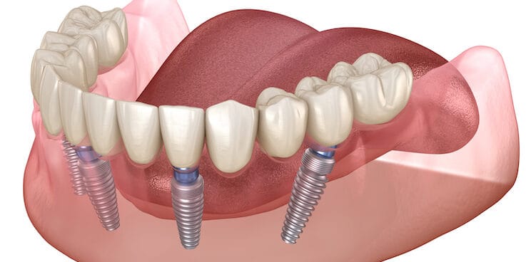 Allon4 Dental implants